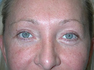 Brow Lift Before and After Pictures Miami, FL