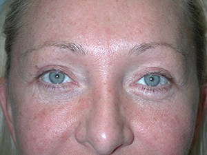 Mini Facelift Before and After Pictures Miami, FL