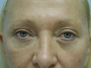 Brow Lift Before and After Pictures Miami, FL