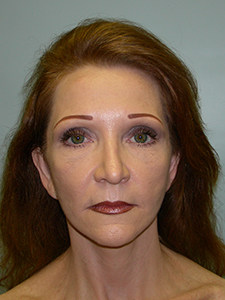 Facelift Before and After Pictures Miami, FL