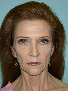 Facelift Before and After Pictures Miami, FL