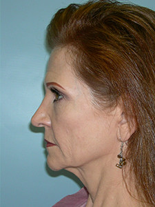 Facelift Before and After Pictures Miami, FL