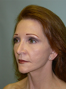 Facelift Before and After Pictures Miami, FL