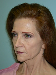 Facelift Before and After Pictures Miami, FL