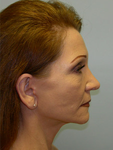 Facelift Before and After Pictures Miami, FL