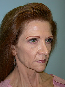 Facelift Before and After Pictures Miami, FL