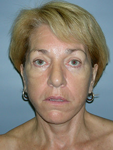 Facelift Before and After Pictures Miami, FL