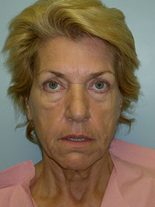 Facelift Before and After Pictures Miami, FL