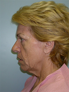 Facelift Before and After Pictures Miami, FL