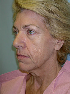 Facelift Before and After Pictures Miami, FL