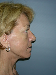 Facelift Before and After Pictures Miami, FL