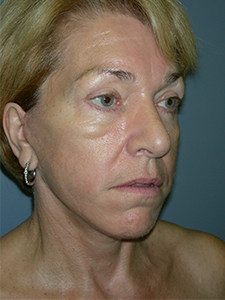 Facelift Before and After Pictures Miami, FL