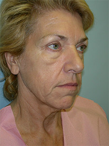 Facelift Before and After Pictures Miami, FL