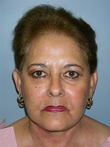 Facelift Before and After Pictures Miami, FL