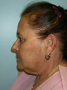 Facelift Before and After Pictures Miami, FL