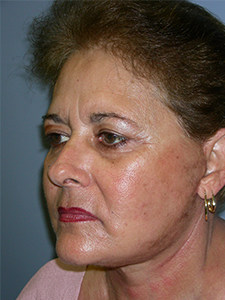 Facelift Before and After Pictures Miami, FL