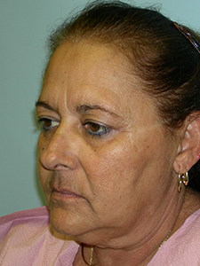 Facelift Before and After Pictures Miami, FL