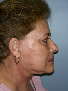 Facelift Before and After Pictures Miami, FL