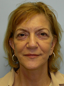 Facelift Before and After Pictures Miami, FL