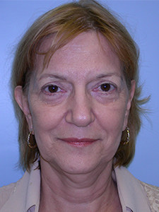 Facelift Before and After Pictures Miami, FL