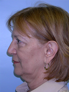 Facelift Before and After Pictures Miami, FL