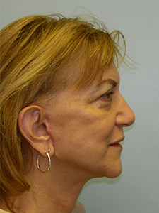 Facelift Before and After Pictures Miami, FL