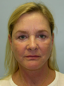 Facelift Before and After Pictures Miami, FL