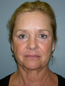 Facelift Before and After Pictures Miami, FL