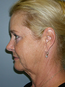 Facelift Before and After Pictures Miami, FL