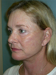 Facelift Before and After Pictures Miami, FL