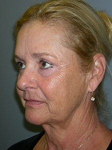 Facelift Before and After Pictures Miami, FL