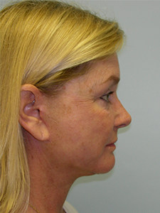 Facelift Before and After Pictures Miami, FL