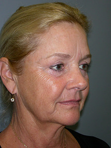 Facelift Before and After Pictures Miami, FL