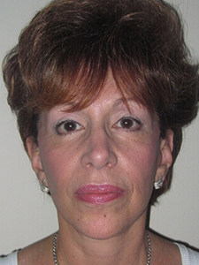 Facelift Before and After Pictures Miami, FL