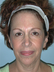 Facelift Before and After Pictures Miami, FL