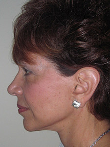 Facelift Before and After Pictures Miami, FL