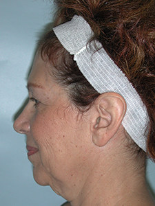 Facelift Before and After Pictures Miami, FL