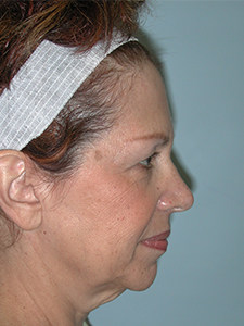 Facelift Before and After Pictures Miami, FL