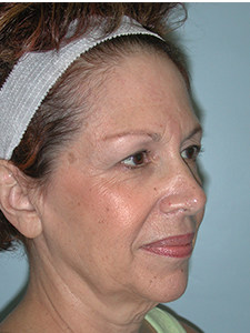 Facelift Before and After Pictures Miami, FL