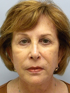 Facelift Before and After Pictures Miami, FL