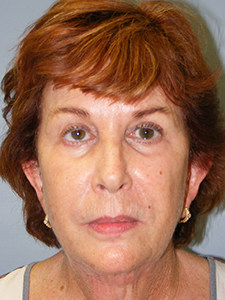 Facelift Before and After Pictures Miami, FL