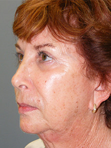 Facelift Before and After Pictures Miami, FL