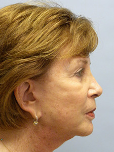 Facelift Before and After Pictures Miami, FL