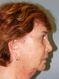 Facelift Before and After Pictures Miami, FL