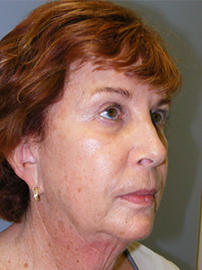 Facelift Before and After Pictures Miami, FL