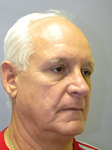 Facelift Before and After Pictures Miami, FL