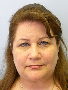 Facelift Before and After Pictures Miami, FL