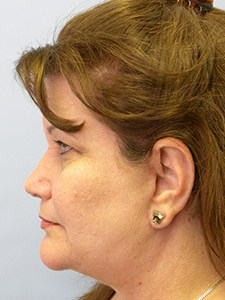 Facelift Before and After Pictures Miami, FL