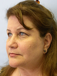 Facelift Before and After Pictures Miami, FL