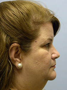 Facelift Before and After Pictures Miami, FL